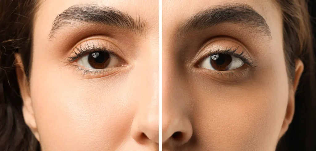 Side-by-side close-up of eyes showing lighter under-eye skin on the left and darker coloration on the right.